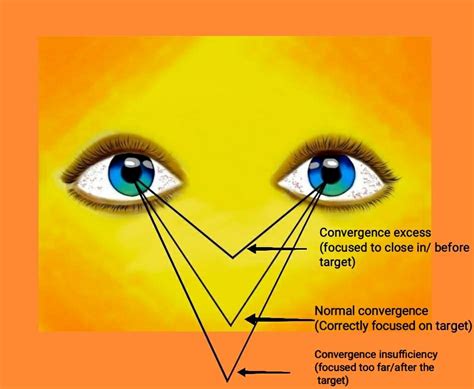 Causes of Asthenopia - Optography