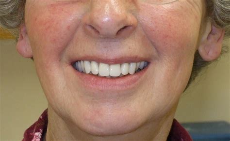 denture 18 after - Portland Dentures & Dental Implants