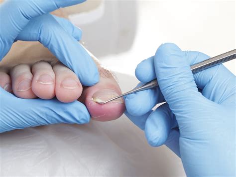 Ingrown Toenail Treatment at MD First Primary & Urgent Care