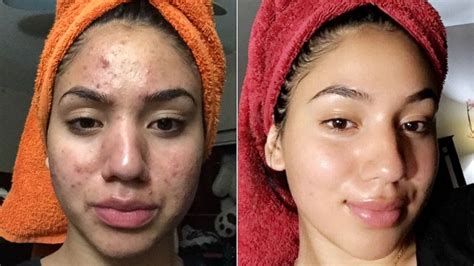 Acne Before And After