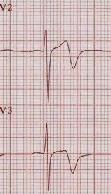 EverydayEmergencyMedicine: Wellens Syndrome