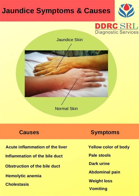 Jaundice Symptoms & Causes