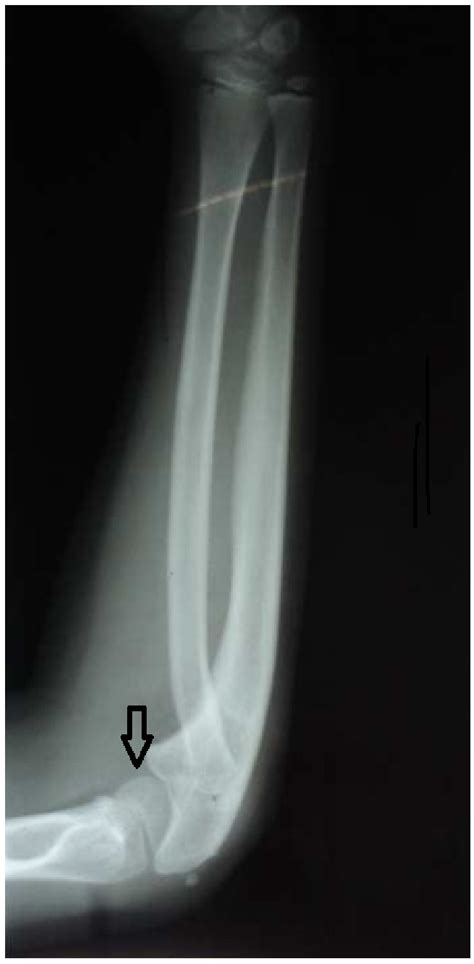 Pre-operative X-ray showing congenital radial head dislocation with the ...