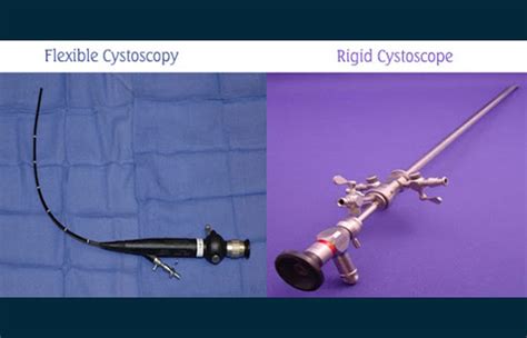 Cystoscopy Treatment and Surgery, Treatment for Cyst