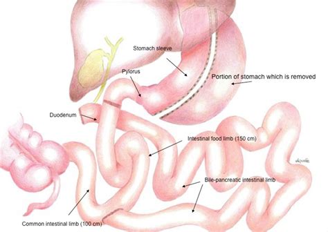 Duodenal Switch obesity surgery Hospital of San Marino