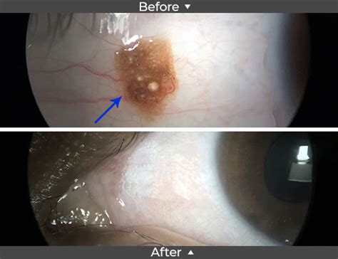 Conjunctival Nevus Removal Before and After Pictures