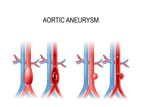 Abdominal Aortic Aneurysm Classification