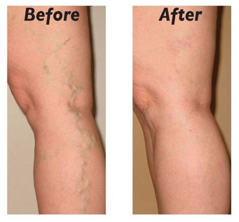 Treatment for Telangiectasia Varicose Veins - Top Varicose Vein ...