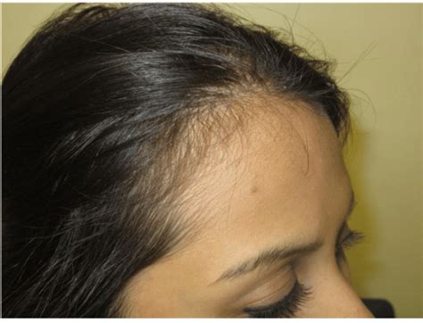 Non-Scarring and Scarring Alopecia | Beauty Beyond the Crown®