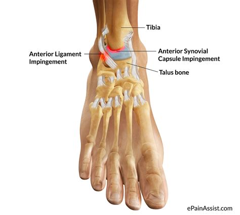 What is Ankle Impingement|Symptoms|Causes|Treatment|Recovery Period ...