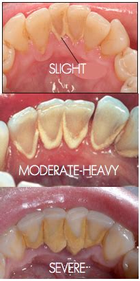 The Difference Between Plaque and Tartar | River Run Dental