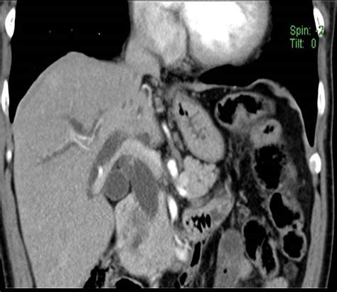 Pancreatic adenocarcinoma – Radiology Cases