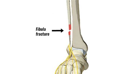 Fibula Fracture - Types, Symptoms, Causes and Rehabilitation