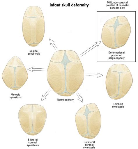 Craniosynostosis causes, symptoms, treatment & craniosynostosis surgery