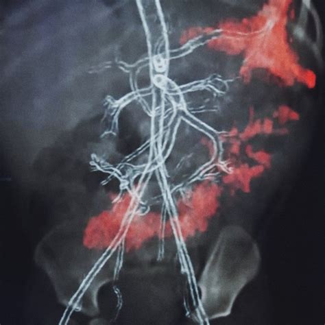 Colonoscopy showing the presence of small angiodysplasia lesions in the ...