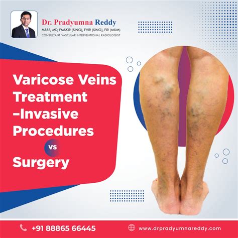 Varicose Veins Treatment - Invasive Procedure vs Surgery