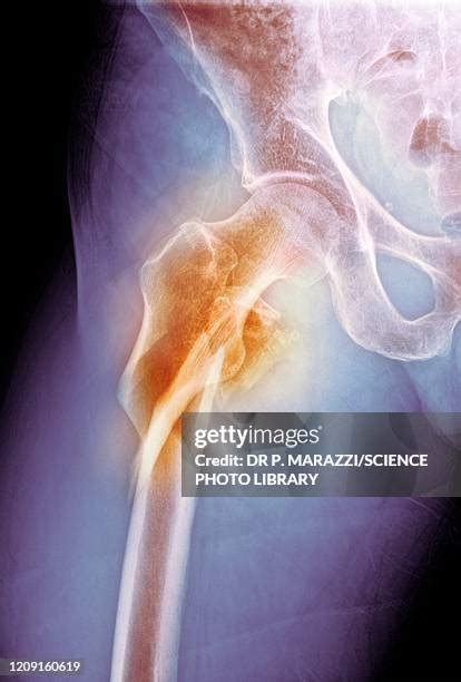 Hip Fracture X Ray Photos and Premium High Res Pictures - Getty Images