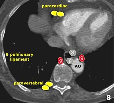 Mediastinal Lymph Node Map