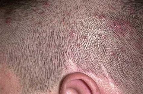 Folliculitis Symptoms & Causes - Folliculitis Treatment - Sussex Trichology