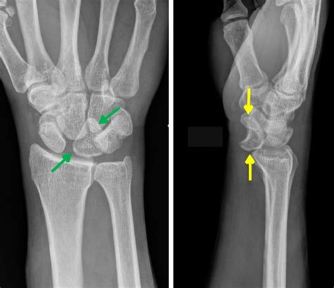 Lunate Dislocation