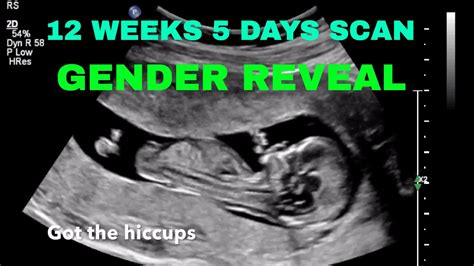 Weeks Days Ultrasound Gender | Hot Sex Picture