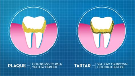 What To Know About Plaque And Tartar – Bracken Barrett