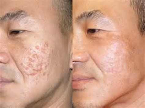 ACNE SCARS LASER RESURFACING: Essence Medispa: Cosmetic Dermatology