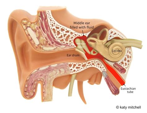 What causes glue ear? — Glue Ear Together