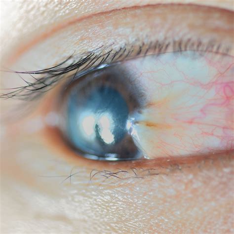 Pterygium Treatment - Merrillville, IN - Surfer’s Eye