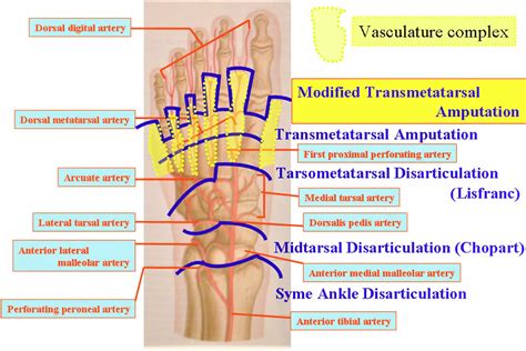 Amputation causes, types of amputation and amputation complications