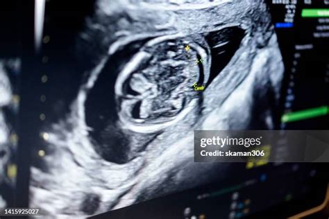 57 12 Weeks Ultrasound Stock Photos, High-Res Pictures, and Images ...