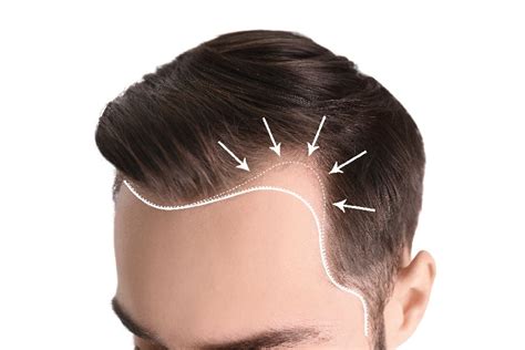 Stages of Receding Hairline, Causes & Treatment – Traya