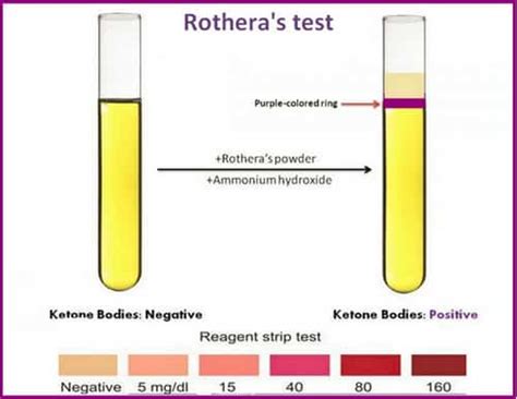 Rothera's Test (Urine ketone bodies test) - Procedure, Principle and ...