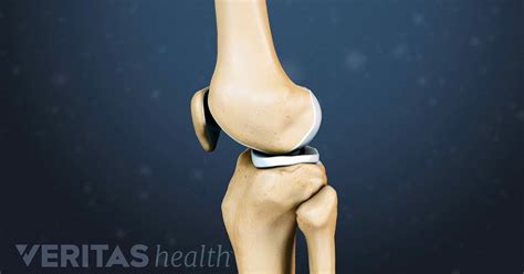 Knee Cartilage Repair, Regeneration, and Replacement