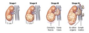 Stages - Kidney Cancer