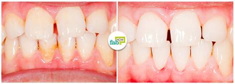 How to Remove Plaque and Tartar from Your Teeth | Fab How