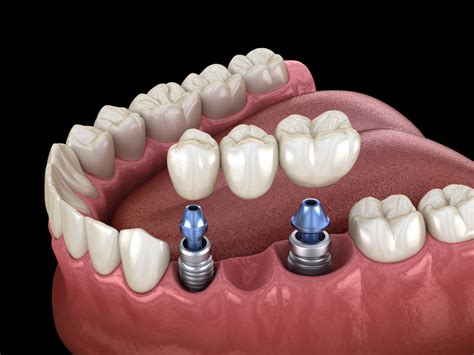 Implant Retained Bridge | Restorative Dental | Hutt Dental Implant Clinic