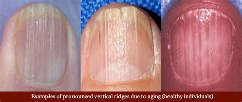 Vertical Ridges in Fingernails - Nail ridges: causes, aging & health!