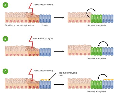 Barretts Esophagus Histology