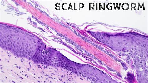 Ringworm under microscope (hair follicle fungus in scalp aka tinea ...