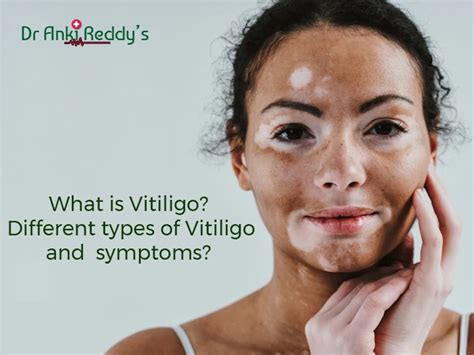 What is Vitiligo? Different types of Vitiligo and symptoms?