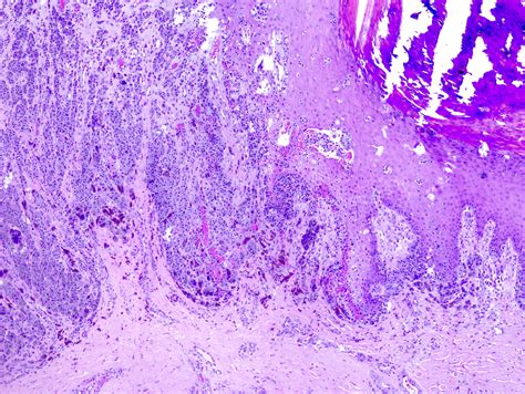 Acral Lentiginous Melanoma Histology