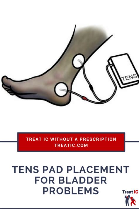 TENs placement for IC: help with bladder urgency and frequency - treat IC