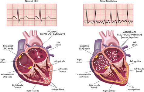 Atrial Fibrillation - Cause, Symptoms, Complications & Treatment in ...