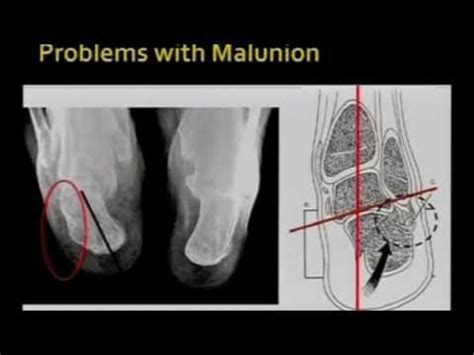 Calcaneal Malunion - YouTube