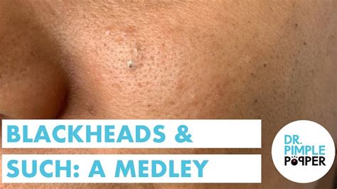 Blackheads or Sebaceous Filaments on the Nose? Extractions - Blackheads ...