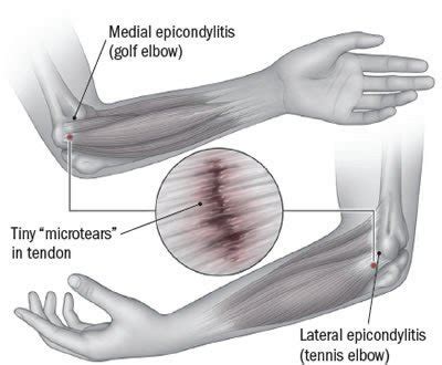 Tennis elbow (lateral epicondylitis) Guide: Causes, Symptoms and ...