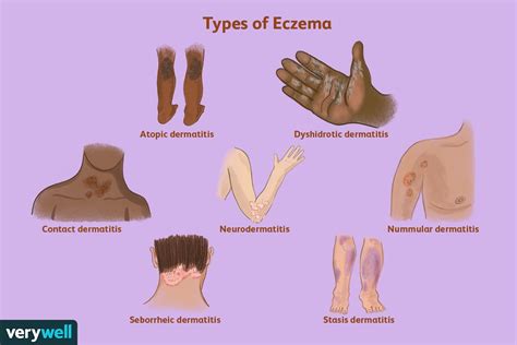 The 7 Types of Eczema: How to Diagnose and Treat Each One