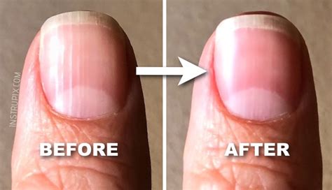 What Those Vertical Lines On Your Nails Mean About Your Health