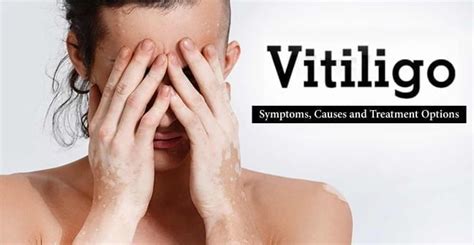 Vitiligo- Symptoms, Causes and Treatment Options